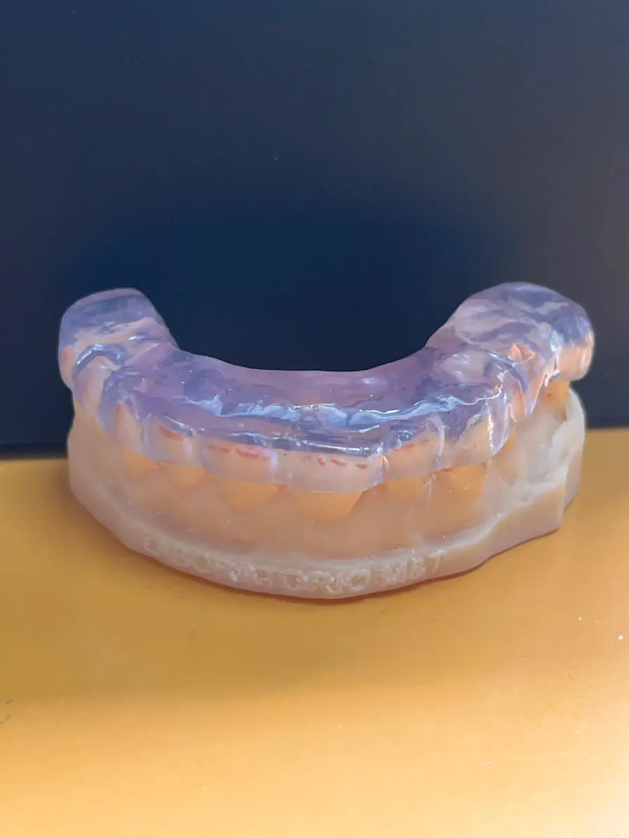 Guarda termoformada montada sobre su modelo impreso en 3D