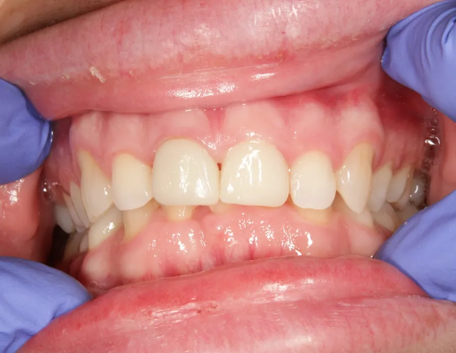 Después del tratamiento: los mismos dientes rehabilitados con coronas