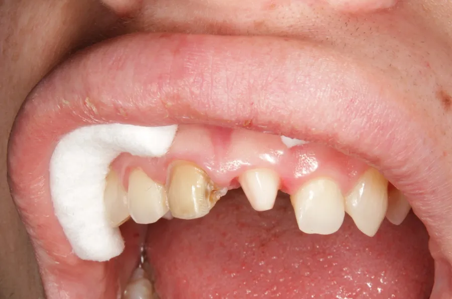 Antes del tratamiento: dientes anteriores superiores con desgaste y pérdida de estructura