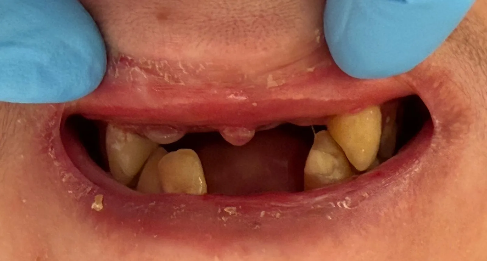 Estado inicial del caso: maxilar superior con pérdida extensa de piezas dentales
