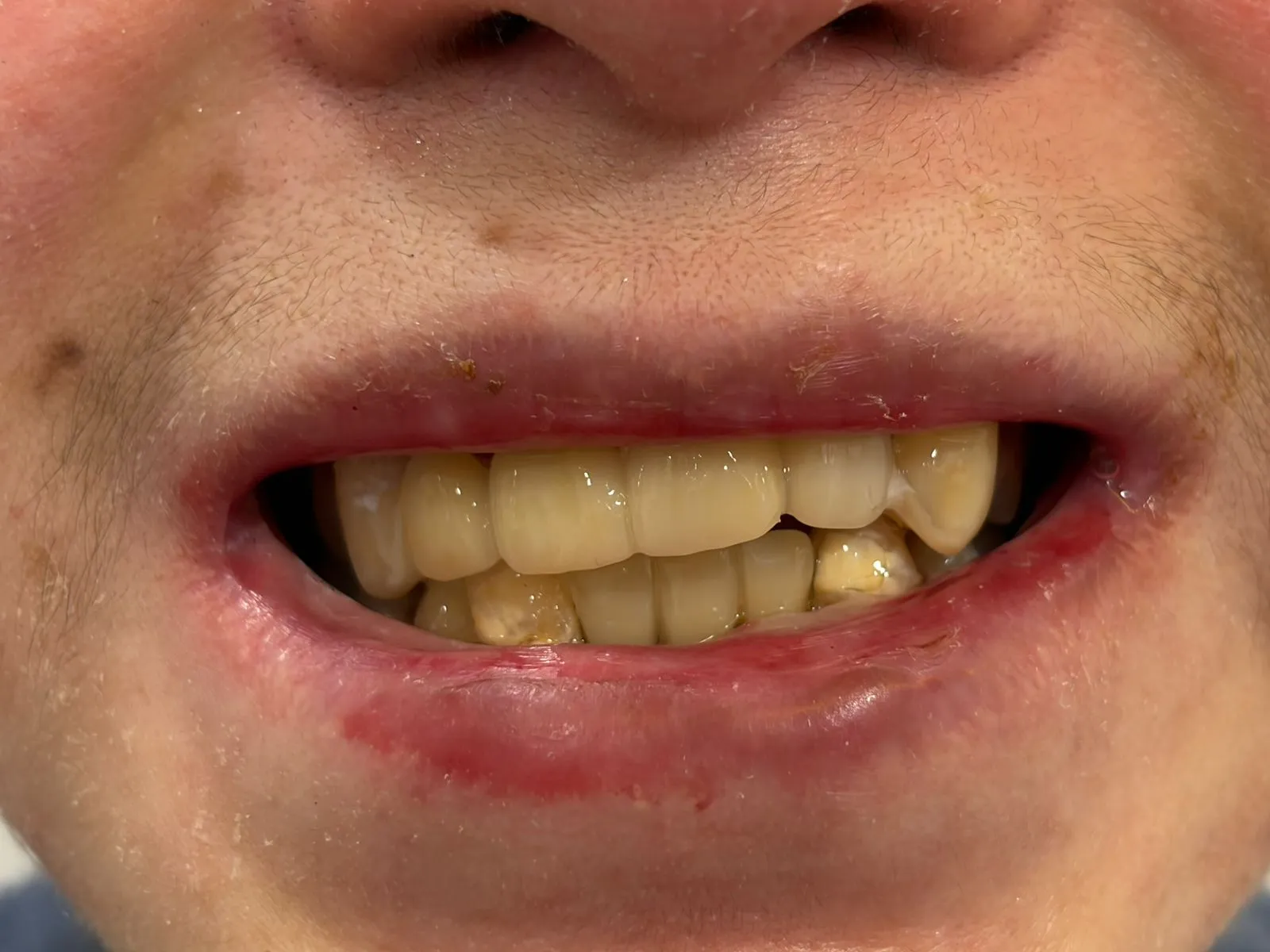Sonrisa del paciente rehabilitada con un puente fijo